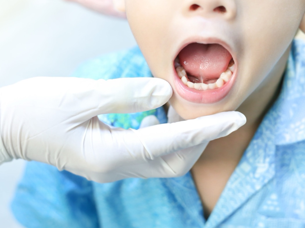 Mãos enluvadas afastando os lábios de uma criança durante o exame intraoral