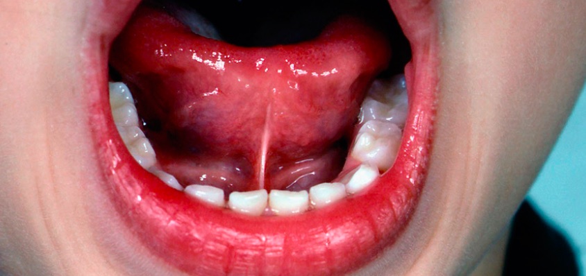 Vista intraoral aproximada da língua elevada, com o frênulo lingual visível no assoalho da boca