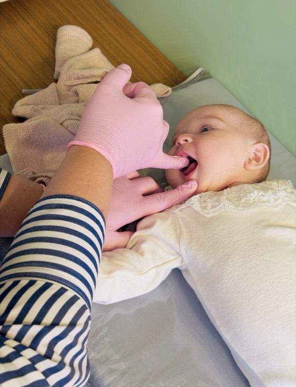 Palpação intraoral em bebê, com luva, durante a avaliação da musculatura oral