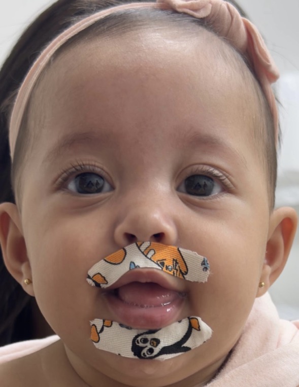 Bandagem elástica aplicada na região perioral de um bebê