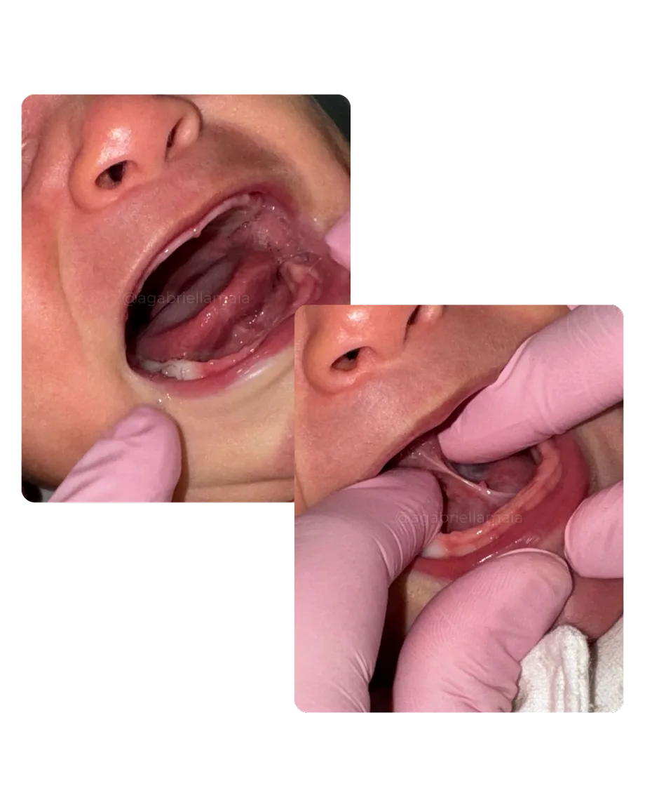 Avaliação clínica real do frênulo lingual em bebê, antes e durante a manobra